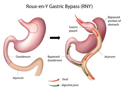 A rendering of a Roux-en-Y Gastric Bypass (RNY)