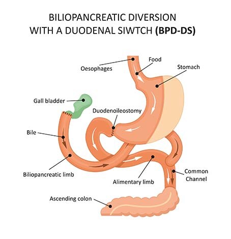 A rendering of a Biliopancreatic Diversion with a Duodenal Switch (BPD-DS)