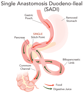 A rendering of a Single Anastomosis Duodenal-Ileostomy with Sleeve Gastrectomy (SADI-S)