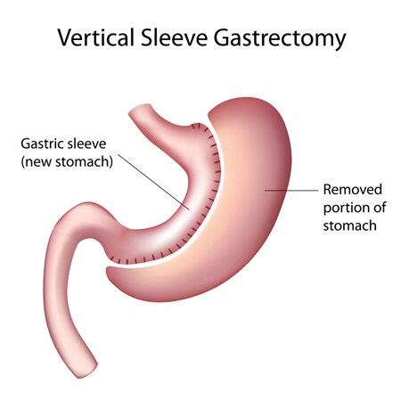 A rendering of a Vertical Sleeve Gastrectomy